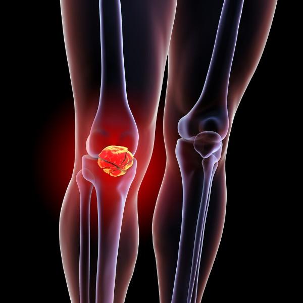 instabilité de la patella instabilité de la patella