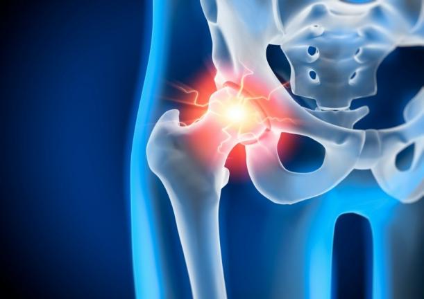 arthrose de la hanche