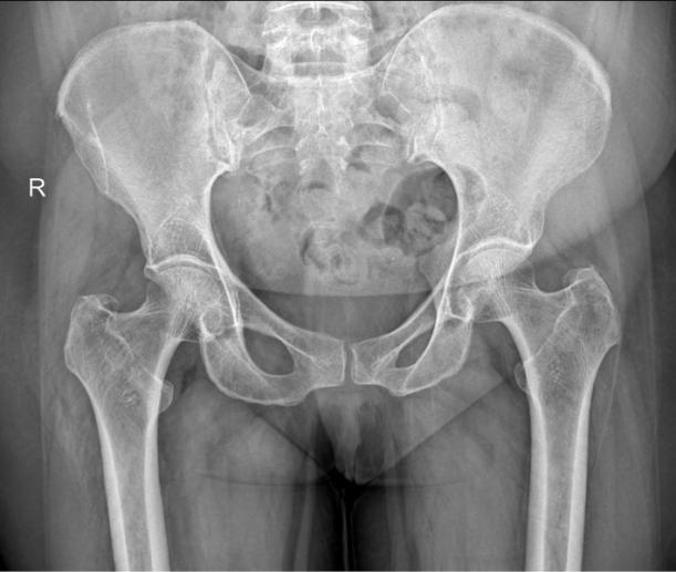 chirurgie tendinite moyen fessier chirurgie tendinite moyen fessier