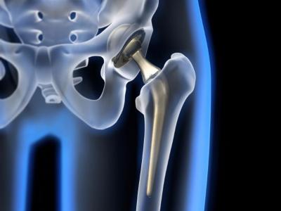 Les voies d’abord pour prothèse totale de hanche